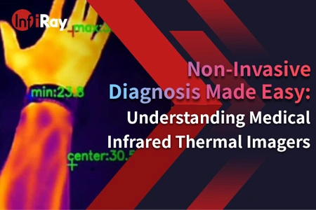 أصبح التشخيص غير الجراحي سهلاً: فهم أجهزة التصوير الحراري بالأشعة تحت الحمراء الطبية